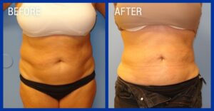 Cold Lipo Before & After Image 1