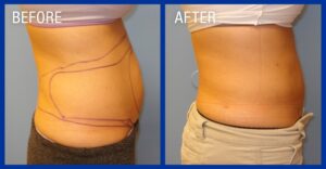 Cold Lipo Before & After Image 2