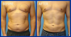 Cold Lipo Before & After Image 3