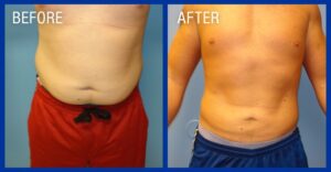 Cold Lipo Before & After Image 5