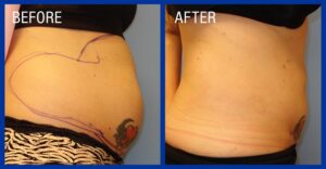 Cold Lipo Before & After Image 7