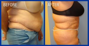 Cold Lipo Before & After Image 8