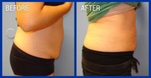 Cold Lipo Before & After Image 9
