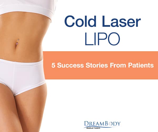 Cold Laser Lipo: 5 Success Stories From Patients
