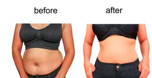 Liposuction - Before & After