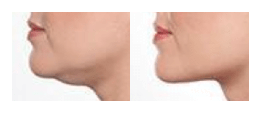 LipoDissolve Vs. Liposuction – The Advantages of LipoDissolve